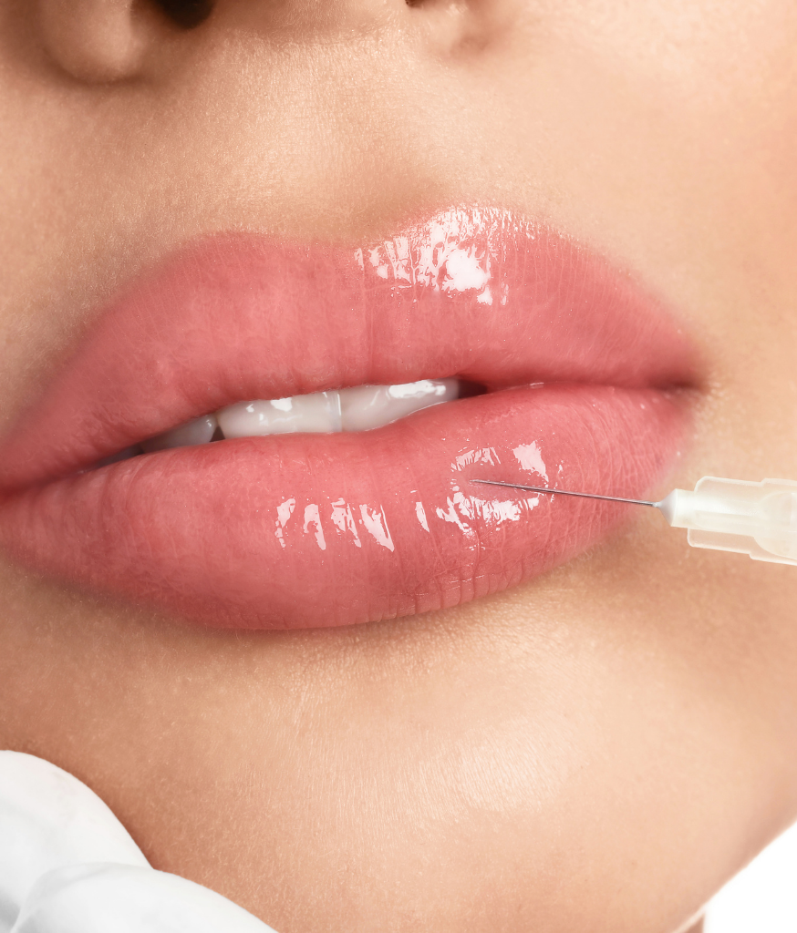 Lip Filler