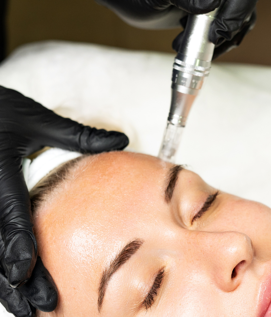 Microneedling 